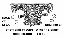 Posterior cervical view of a right subluxation of Atlas